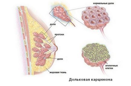 Tipuri invazive de cancer mamar, simptome, etape, diagnostic, tratament