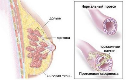 Tipuri invazive de cancer mamar, simptome, etape, diagnostic, tratament