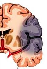 Ischemic cerebral accident vascular cerebral, simptome, tratament, consecințe