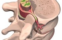 Sciatica ce este și cum să scapi de ea