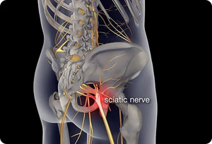 Sciatica simptome și medicamente medicamente, remedii populare