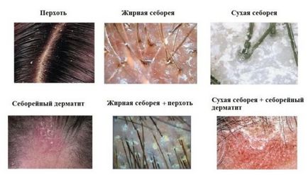 Utilizarea unui rand în tratamentul dermatitei atopice