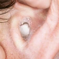 Hogyan kell kezelni a fülgyulladás