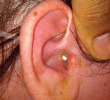 Cum să facem față infecției cu urechea