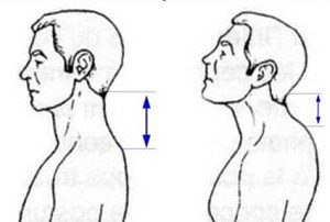 Cum să tratați hiperlordoza coloanei vertebrale cervicale