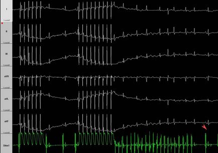 Cum se determină forma fibrilației atriale în absența unei electrocardiograme în timpul unui atac,
