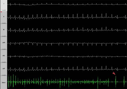 Cum se determină forma fibrilației atriale în absența unei electrocardiograme în timpul unui atac,