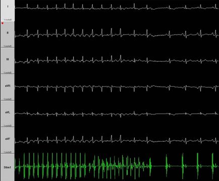Cum se determină forma fibrilației atriale în absența unei electrocardiograme în timpul unui atac,