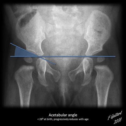 Як визначити вроджений вивих стегна по рентгену