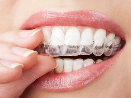 Hogyan fehéríti a fogakat otthon