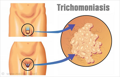 Cum să distingem afulația de trichomoniază a asemănărilor și diferențelor dintre ele