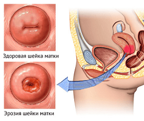 Як проявляється ерозія шийки матки і чи може вона перерости в рак