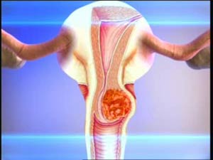 Cum se manifestă eroziunea cervicală și se poate dezvolta în cancer