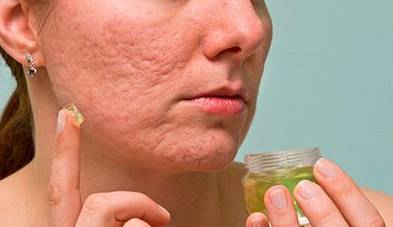 Cum să eliminați cicatricile de la cicatricile acneice