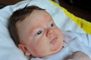 Picături și gel Fenistil pentru nou-născuți - indicații de utilizare, contraindicații și recomandări