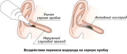 Căderi de la prizele de urechi - ce să săpăm în ureche pentru purificarea sulfului