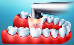 Caries - noi tehnologii în tratament