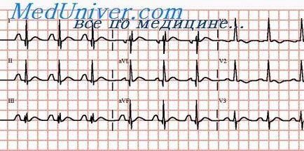 Clinica de cardiomiopatie alcoolică