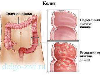 Kolit și calitatea vieții pacientului