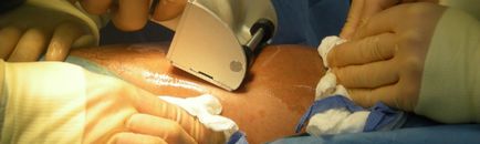 Piele plastică - transplant de piele cu defecte largi ale plăgii