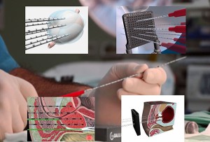 Cryoablation - cum să tratați cancerul cu ajutorul înghețării