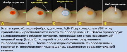 Кріоабляція - як лікують рак за допомогою заморожування