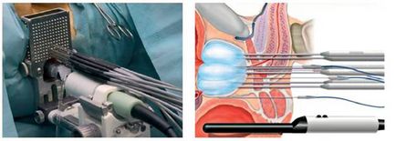 Cryoablation - cum să tratați cancerul cu ajutorul înghețării