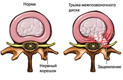 Лікування грижі хребта без операції консервативна і народна медицина