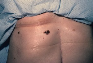 Tratamentul melanomului cutanat la Moscova, Israel, Institutul Herzen