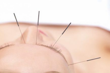 Tratamentul nevralgiei cu acupunctura - tratamentul nervului trigeminal si facial prin acupunctura in spb