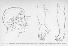 Tratamentul neuralgiei trigeminale, reflexologie