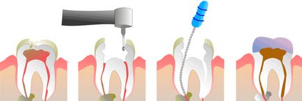 Лікування пульпіту зубів і інші ендодонтичні послуги