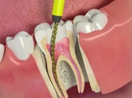 Tratamentul pulpitei dinților și al altor servicii endodontice