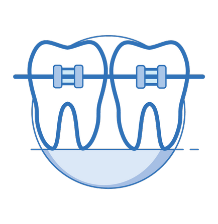 Лінгвальні брекети - доступні ціни в dentalway