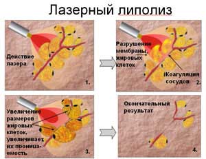 Liposucția abdomenului