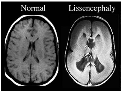 Lysensence, simptome, semne, diagnostic și tratament