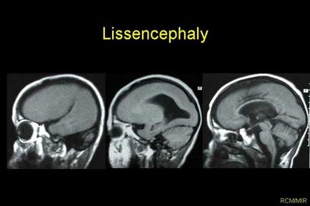 Lysensence, simptome, semne, diagnostic și tratament