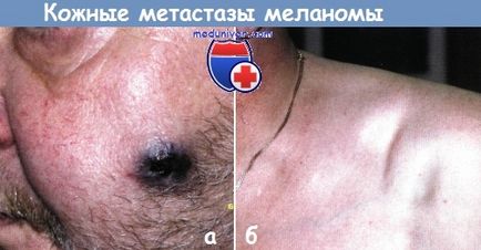 Metastaza melanomului la nivelul pielii