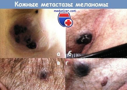 Metastaza melanomului la nivelul pielii