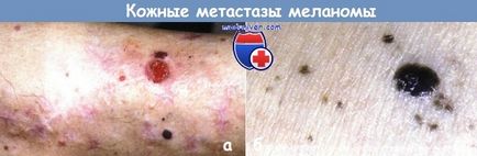 Metastaza melanomului la nivelul pielii