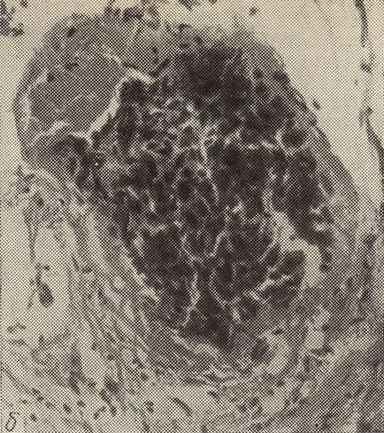 Metastaza tumorilor - tumori - anatomie patologică - cititor de miere