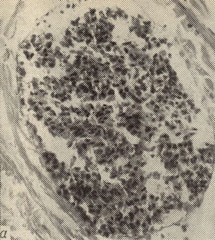 Metastaza tumorilor - tumori - anatomie patologică - cititor de miere