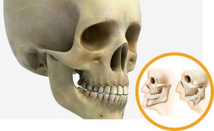 Micrognathia a mandibula - hypoplasia, hypoplasia