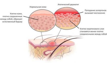 Чи можна ходити в солярій при дерматиті