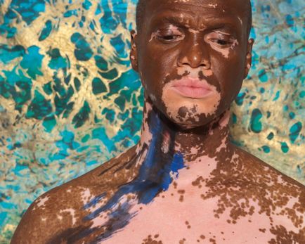 Fie că este posibil să faceți plajă la vitiligo pe mare și într-o punte de soare