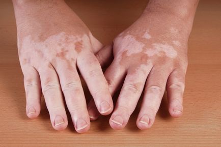 Fie că este posibil să faceți plajă la vitiligo pe mare și într-o punte de soare