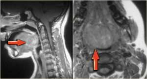 MRI a torok és a gége, mikor nem MRI vagy CT a gége, akár MRI torok emberi nyelőcső mutatja ár