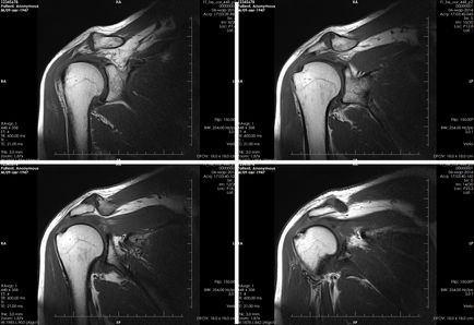 Мрт плечового суглоба - показання, протипоказання, хід процедури обстеження