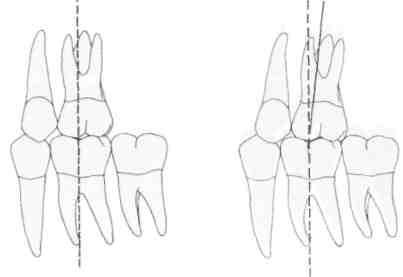 Tuburi molare offset
