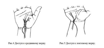 Chirurgie pe nervii mâinii, traumatologie pentru toți